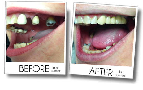 Tooth replacement, dental bridge, dental crowns, before and after of an actual dental case
