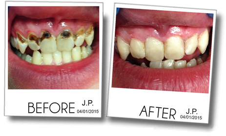 Teeth with severe decay is restored by composite, white dental filling and bonding. 